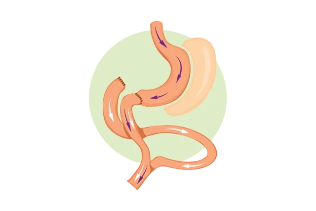 Duodenal switch graphic