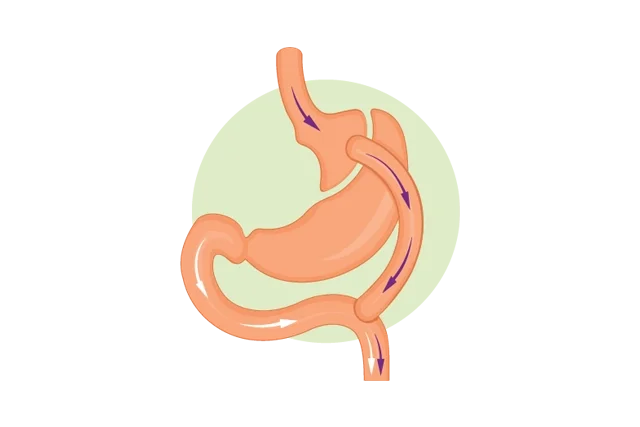 Roux-en-Y Gastric Bypass graphic