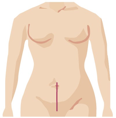 Traditional surgery incision for gynecologic surgery