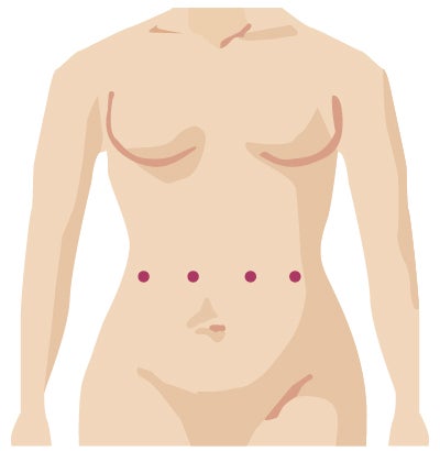 Robotic surgery incision from gyn onc surgery